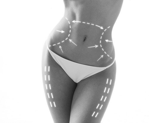 traitement cellulite lyon cryolipolyse liposuccion