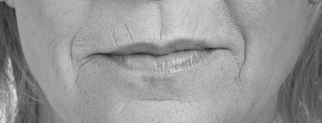 rideS lèvre bouche acide hyaluronique