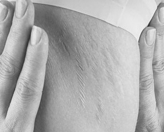 traitement vergetures laser peeling