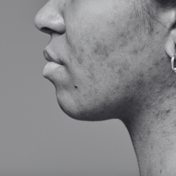 Enlever les tâches brunes