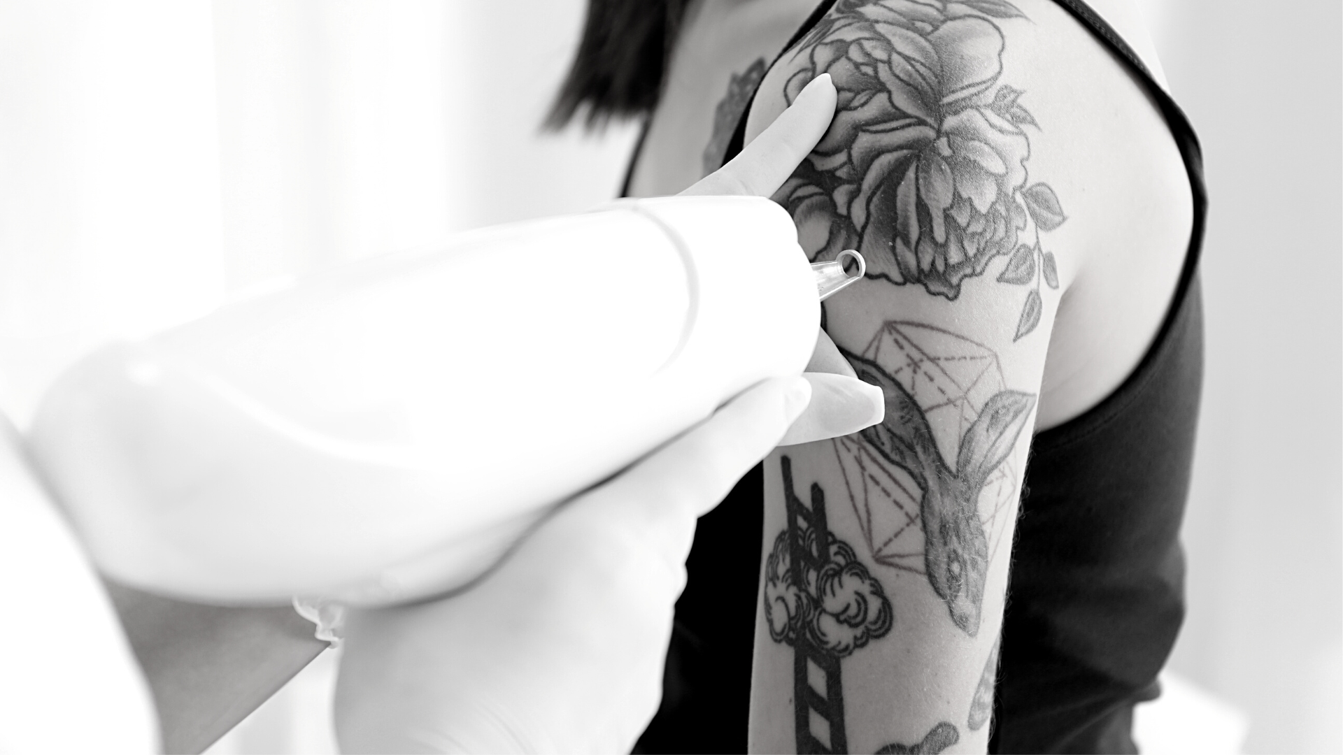 séance de détatouage au laser picoseconde à Lyon