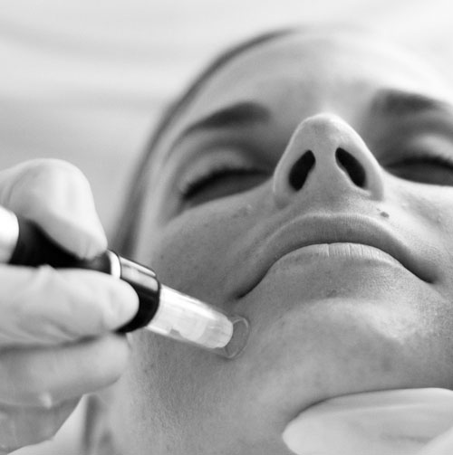 microneedling Clinique Crillon Lyon regeneration illumination peau