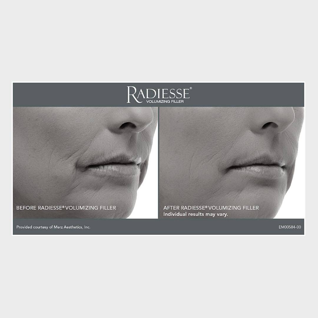 RADIESSE + : inducteur collagénique
